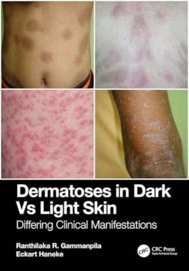Dermatoses In Dark Vs Light Skin Differing Clinical Manifest