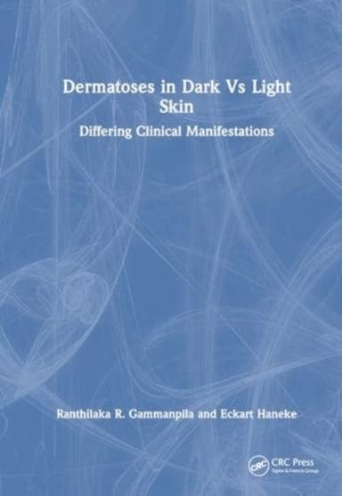 Dermatoses In Dark Vs Light Skin Differing Clinical Manifest